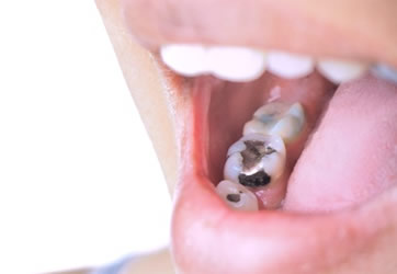 奥歯銀歯