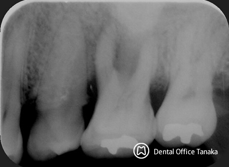 歯周病骨吸収